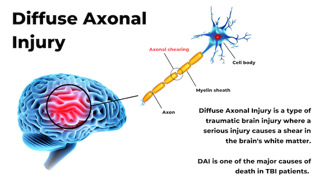 Diffuse Axonal Injury