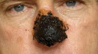 skin cancer on the nose