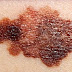 MELANOMA