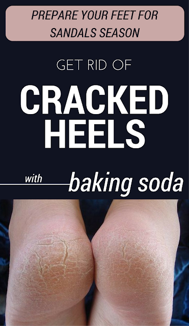 Prepare Your Feet For Sandals Season: Get Rid Of Cracked Heels With Baking Soda