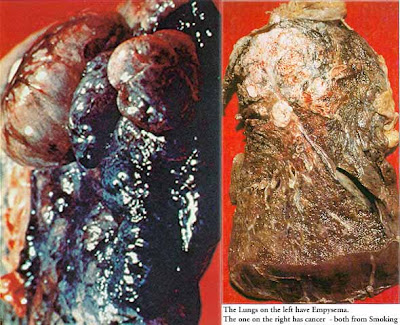 pics of lungs before and after smoking. smoking lungs before and after