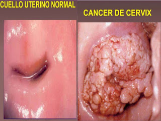  imagen 2 verrugas virus papiloma humano, curación del virus del papiloma humano