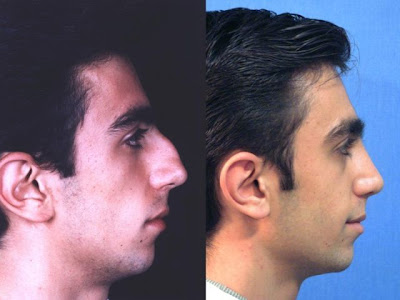 Interesting Before and After Nose Surgery Seen On www.coolpicturegallery.us