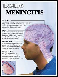 Warning to the disease meningitis.
