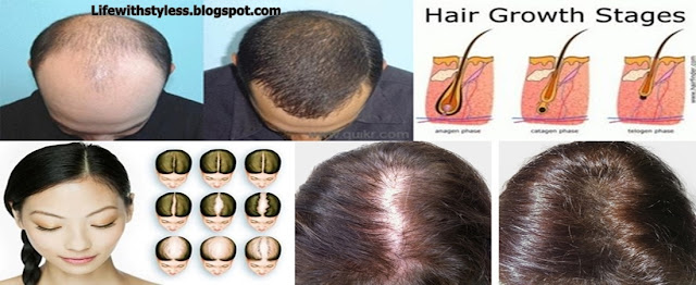 Hair-fall and Baldness - Check Out How to Make Hair Re-Grow in Bald Spots! QUICK n EFFECTIVE!