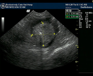 Blood Clot in Urinary Bladder