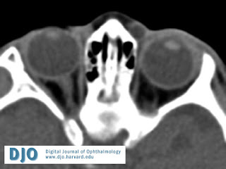 Oculoplastia