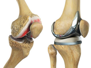 knee replacement Ireland