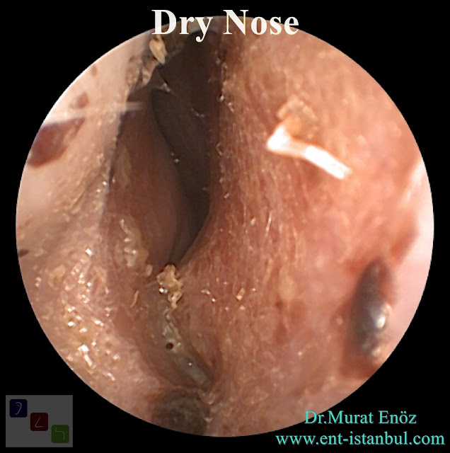 Dry Nose