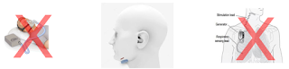 StimAire neuromodulation platform obstructive sleep apnea