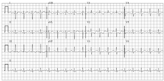 Right heart strain EKG