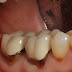 Nguyên nhân viền chân răng bị đen 