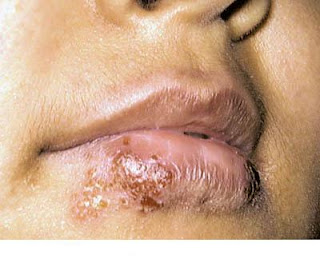 Treating Herpes Itching : Genital Herpes Treatment Advancements