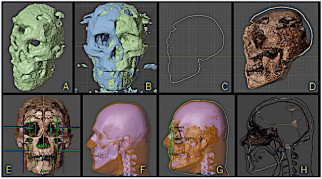 Некоторые этапы фотограмметрии черепа и начальной анатомической деформации