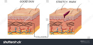 What is stretch marks 