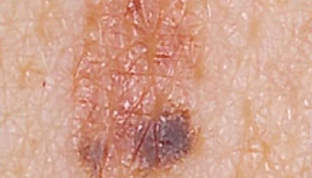 malignes melanom Entwicklung frühstadium bilder