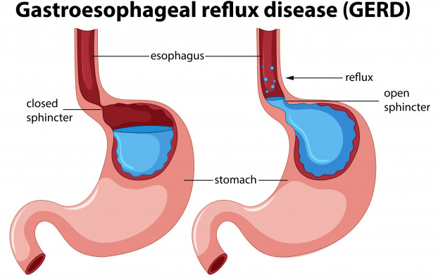 Know when to go to the doctor in Anti Reflux (Gerd Surgery)