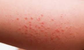 Anyone who has been vaccinated against the BioNTech COVID-19 vaccine can get seasonal allergies