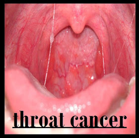 treatment for throat cancer radiation therapy and chemotherapy image