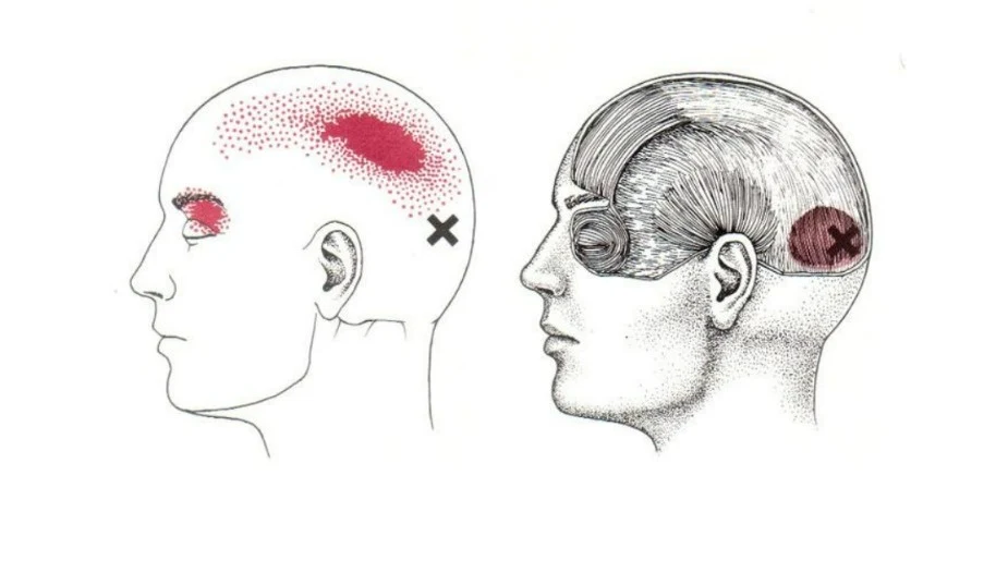 dolor cervical y de cabeza - occipito frontal - referido - mcdevservices spa