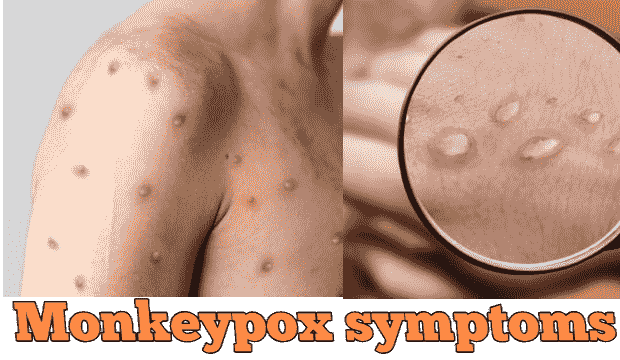 Monkeypox symptoms in marathi