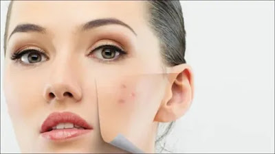 Natural Remedies for Acne-Prone Skin and Blemishes