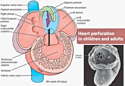 Heart perforation in children and adults  ثقب القلب عند الأطفال والبالغين