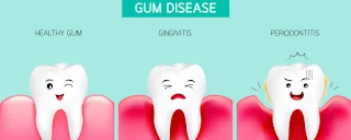 gum disease