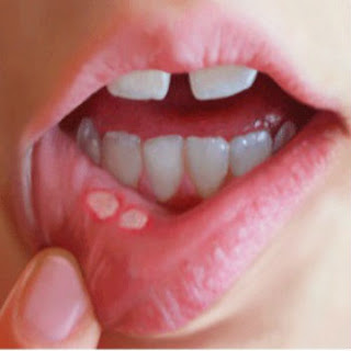 mouth ulcers causes