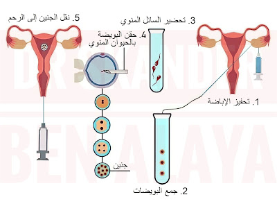 لتلقيح المجهري