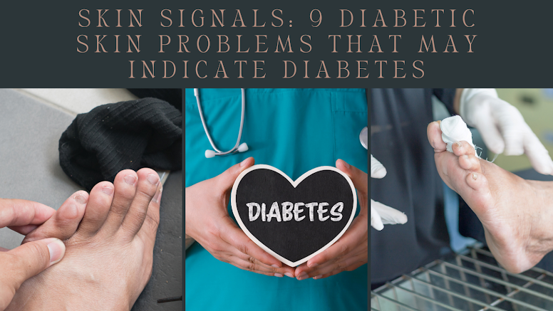 diabetic skin problems, diabetic, diabetes symptoms, type 2 diabetes, diabetes mellitus,type 1 diabetes, hba1c, prediabetes, diabetes insipidus, gestational diabetes, hyperglycemia,