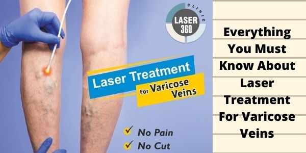 Varicose Veins Treatment Delhi