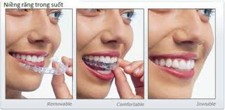 Niềng răng invisalign có tốt không?