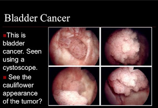 Bladder Cancer Pictures From Cystoscopy2