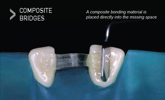 Lepas retainer, composite bridge pula