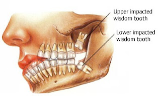 Dents de sagesse