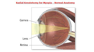 Radial Keratotomy for Myopia - Normal Anatomy