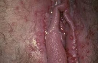 herpes genital en la vulva