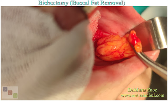 Bichectomy, Buccal Fat Removal, Buccal fat extraction, Hollywood cheek, Cheek Thinning Surgery, Cheek Fat Removal, Extended buccal lipectomy