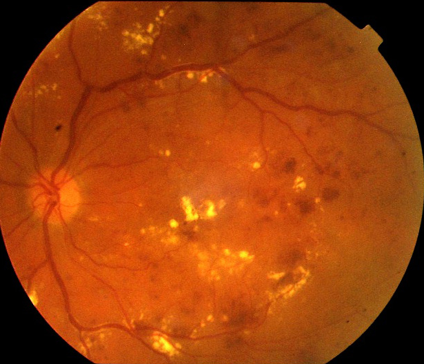 diabetic retinopathy risk factors and it's stages