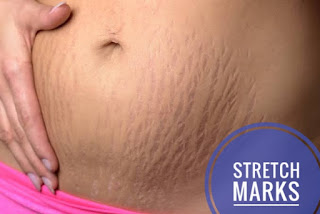 Best Ways of Removing Stretch Marks