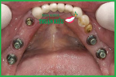 dental-implants-in-vietnam-dental-implants-nha-khoa-thuan-kieu-tphcm