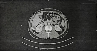 CT scan of torso cross section (copyrighted image)