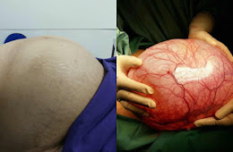  Wanita Ini Gembira CYST 10cm Kecut Tinggal 2cm Tak Sampai Sebulan!