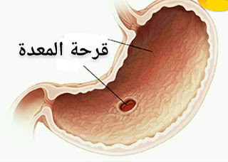 اعراض قرحة المعدة و الاثنى عشر