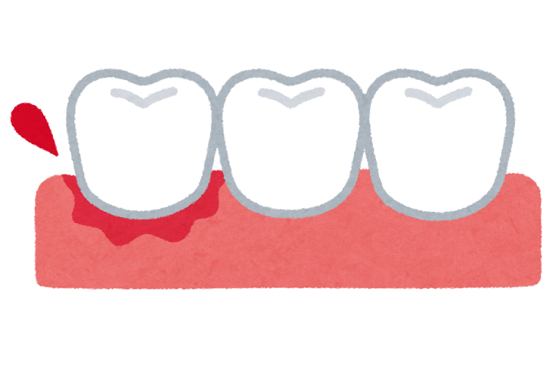歯肉出血のイラスト かわいいフリー素材集 いらすとや