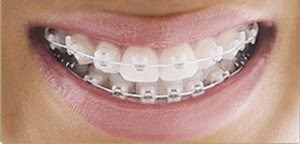 Kỹ thuật niềng răng mắc cài kim loại giá bao nhiêu tiền?