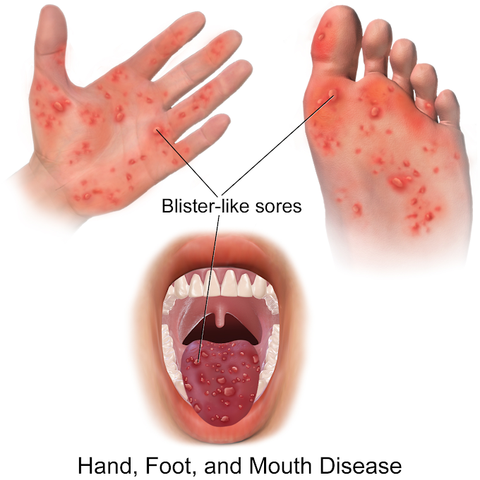 5 Cara Cegah Penyakit Tangan, Mulut Dan Kaki (HMFD)