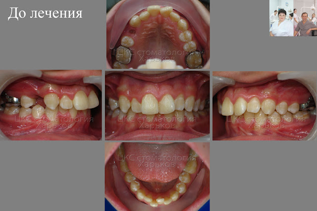 Зубы  пациента до лечения брекетами