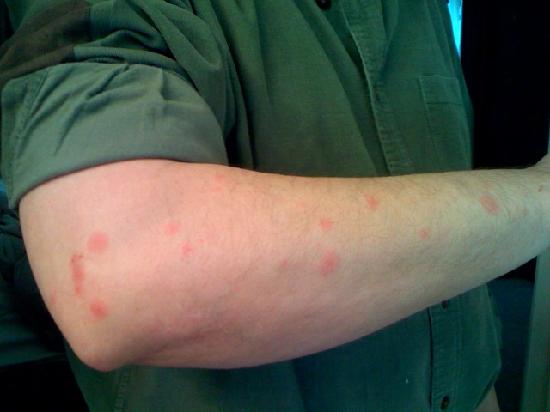 Bugbruise bite using the orange soap Is jan nadinola tips and go have loads 